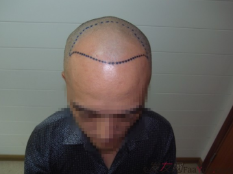 在上海植信植發(fā)歸來，分享一年來的變化