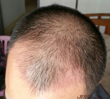 在上海植信植發(fā)歸來，分享一年來的變化