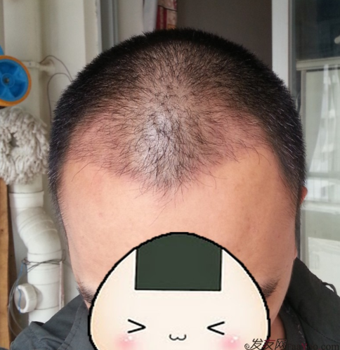 在上海植信植發(fā)歸來，分享一年來的變化