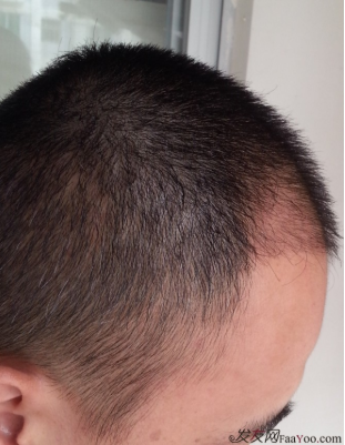 在上海植信植發(fā)歸來，分享一年來的變化