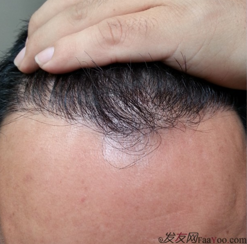 在上海植信植發(fā)歸來，分享一年來的變化