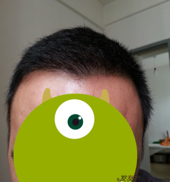 在上海植信植發(fā)歸來，分享一年來的變化