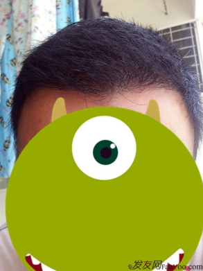 在上海植信植發(fā)歸來，分享一年來的變化