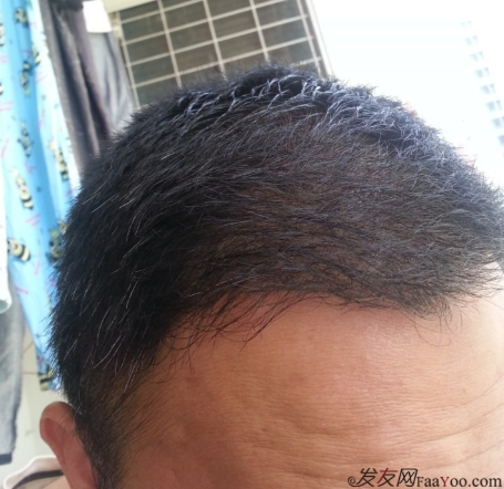 在上海植信植發(fā)歸來，分享一年來的變化