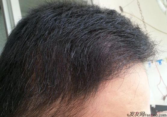 在上海植信植發(fā)歸來，分享一年來的變化