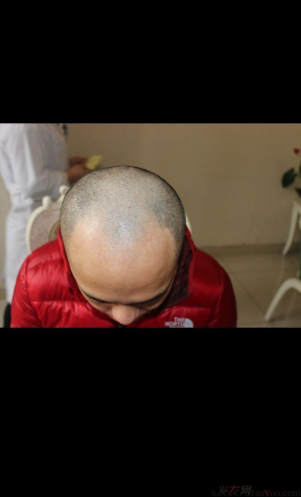 成都大麥微針醫(yī)院3400個(gè)單位，蛻變現(xiàn)在開始！