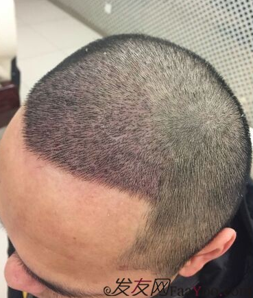 成都大麥微針醫(yī)院3400個(gè)單位，蛻變現(xiàn)在開始！