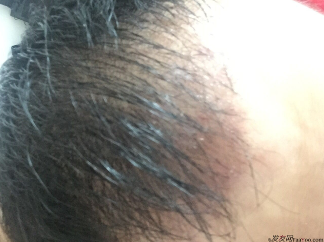 成都大麥微針醫(yī)院3400個(gè)單位，蛻變現(xiàn)在開始！