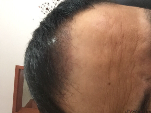 成都大麥微針醫(yī)院3400個(gè)單位，蛻變現(xiàn)在開始！