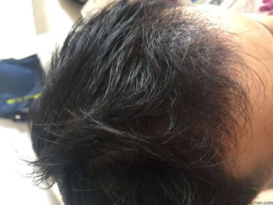 成都大麥微針醫(yī)院3400個(gè)單位，蛻變現(xiàn)在開始！