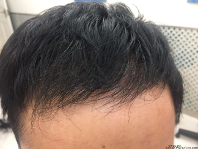 成都大麥微針醫(yī)院3400個(gè)單位，蛻變現(xiàn)在開始！