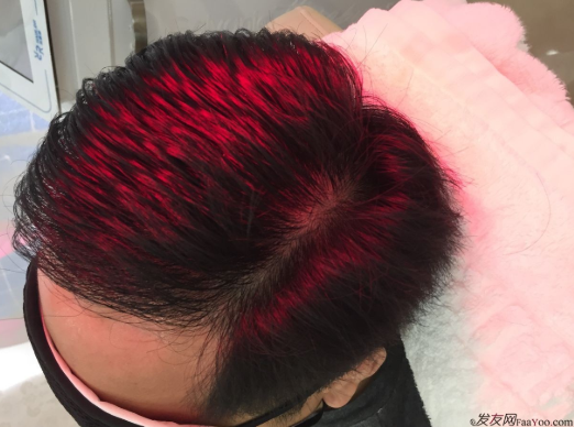 成都大麥微針醫(yī)院3400個(gè)單位，蛻變現(xiàn)在開始！