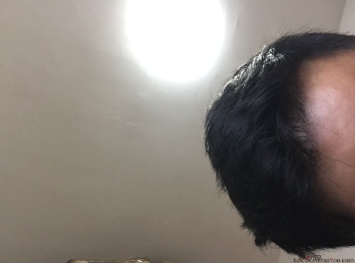 成都大麥微針醫(yī)院3400個(gè)單位，蛻變現(xiàn)在開始！