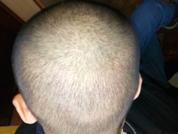 我終于下定決心了，成都大麥微針植發(fā)3200單位&nbsp;