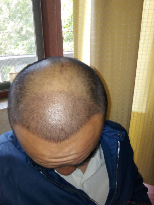 我終于下定決心了，成都大麥微針植發(fā)3200單位&nbsp;