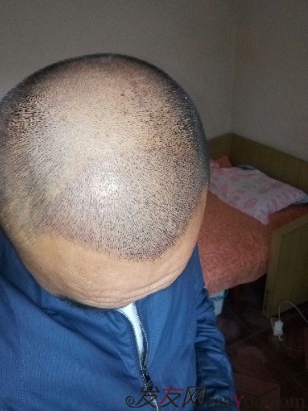 我終于下定決心了，成都大麥微針植發(fā)3200單位&nbsp;