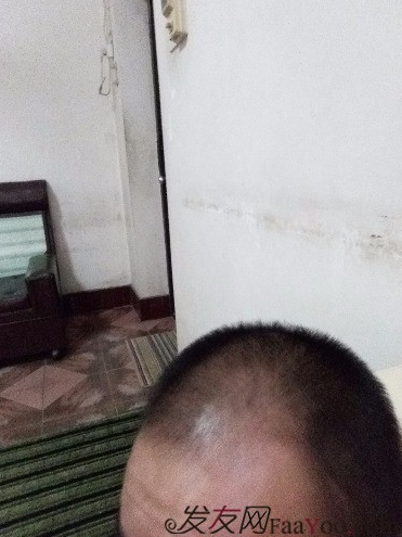 我終于下定決心了，成都大麥微針植發(fā)3200單位&nbsp;