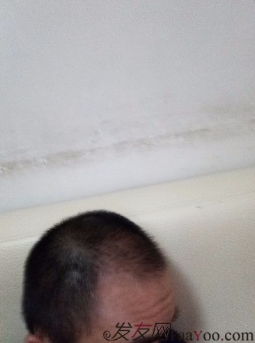 我終于下定決心了，成都大麥微針植發(fā)3200單位&nbsp;