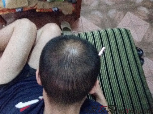 我終于下定決心了，成都大麥微針植發(fā)3200單位&nbsp;