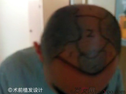 杭州大麥微針pse+fue=3884，新年一切從頭開始！