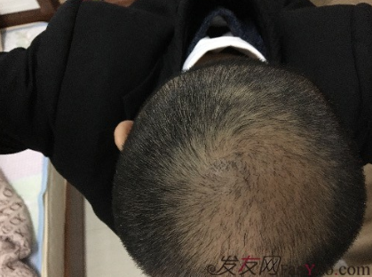 杭州大麥微針pse+fue=3884，新年一切從頭開始！