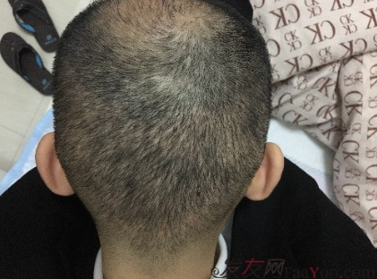 杭州大麥微針pse+fue=3884，新年一切從頭開始！