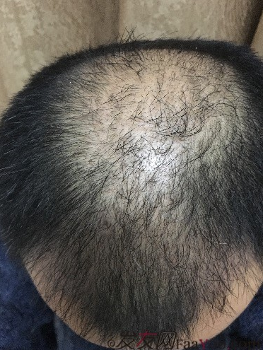 杭州大麥微針pse+fue=3884，新年一切從頭開始！