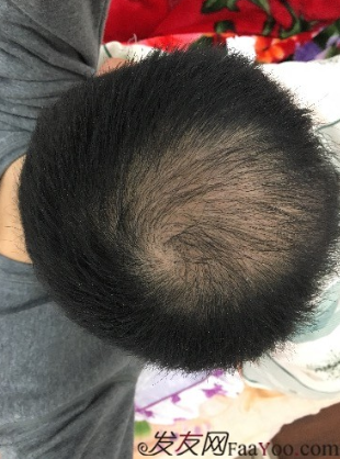 杭州大麥微針pse+fue=3884，新年一切從頭開始！