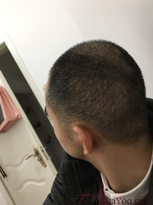 杭州大麥微針pse+fue=3884，新年一切從頭開始！