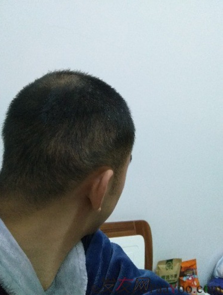 杭州大麥微針pse+fue=3884，新年一切從頭開始！