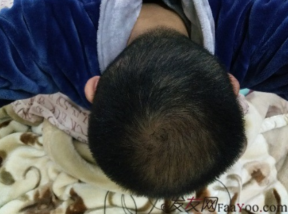 杭州大麥微針pse+fue=3884，新年一切從頭開始！