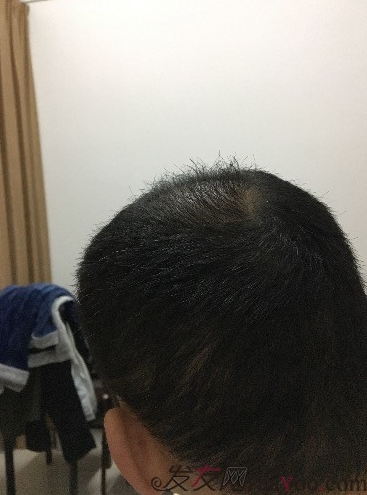 杭州大麥微針pse+fue=3884，新年一切從頭開始！