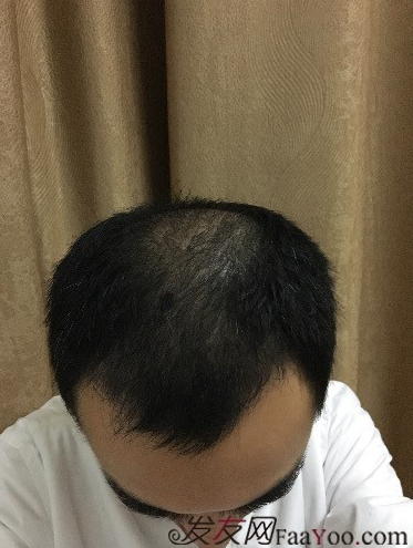 杭州大麥微針pse+fue=3884，新年一切從頭開始！