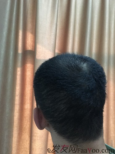 杭州大麥微針pse+fue=3884，新年一切從頭開始！