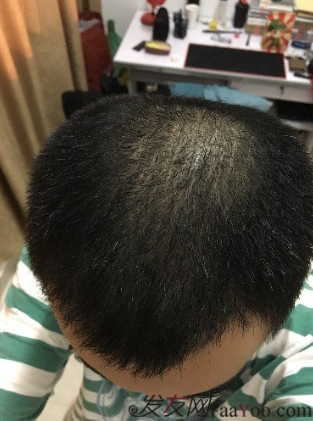 杭州大麥微針pse+fue=3884，新年一切從頭開始！