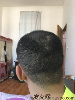 杭州大麥微針pse+fue=3884，新年一切從頭開始！