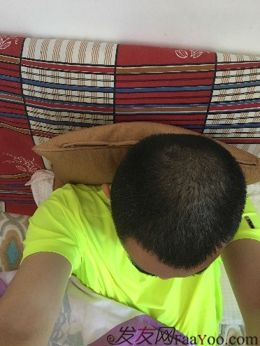 杭州大麥微針pse+fue=3884，新年一切從頭開始！