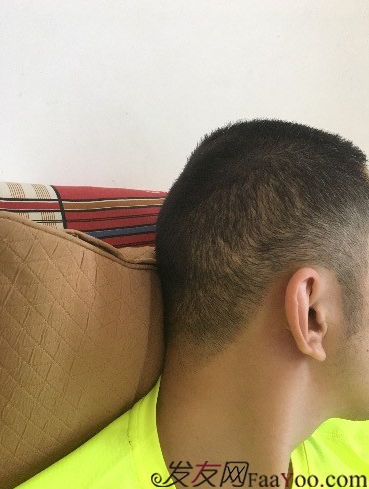 杭州大麥微針pse+fue=3884，新年一切從頭開始！