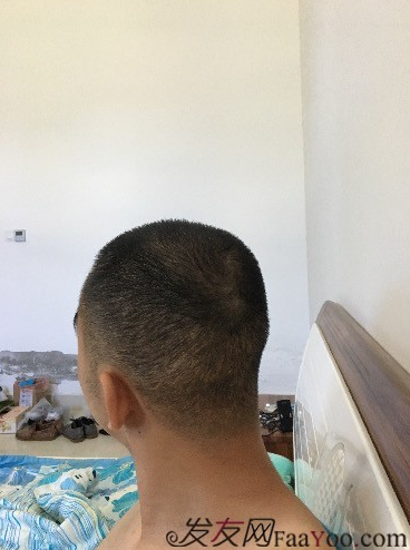 杭州大麥微針pse+fue=3884，新年一切從頭開始！