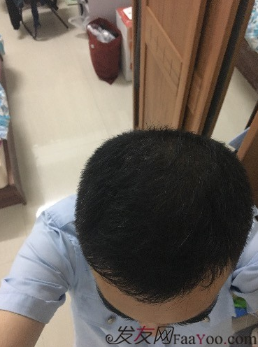 杭州大麥微針pse+fue=3884，新年一切從頭開始！