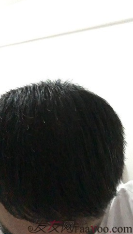 杭州大麥微針pse+fue=3884，新年一切從頭開始！