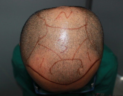 植發(fā)案例：感謝成都大麥微針植發(fā)王主任，咱是卷發(fā)咱怕誰