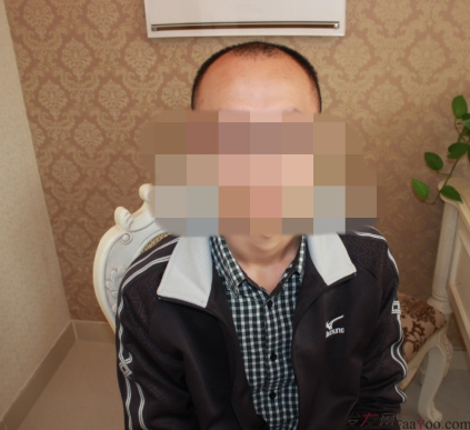 植發(fā)案例：感謝成都大麥微針植發(fā)王主任，咱是卷發(fā)咱怕誰