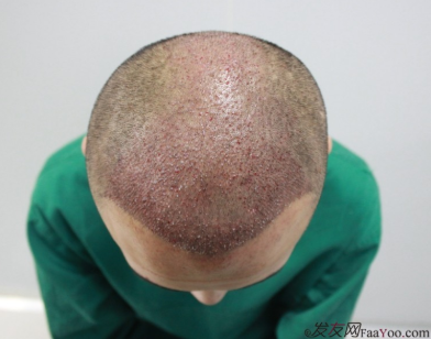 植發(fā)案例：感謝成都大麥微針植發(fā)王主任，咱是卷發(fā)咱怕誰