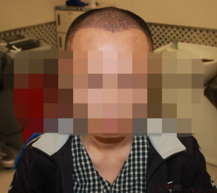 植發(fā)案例：感謝成都大麥微針植發(fā)王主任，咱是卷發(fā)咱怕誰