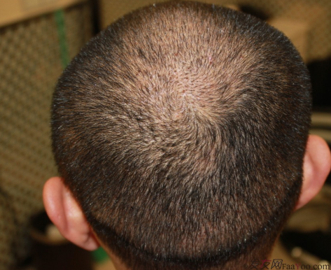 植發(fā)案例：感謝成都大麥微針植發(fā)王主任，咱是卷發(fā)咱怕誰