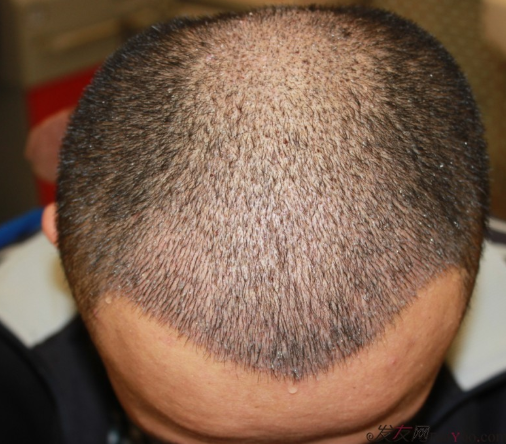 植發(fā)案例：感謝成都大麥微針植發(fā)王主任，咱是卷發(fā)咱怕誰