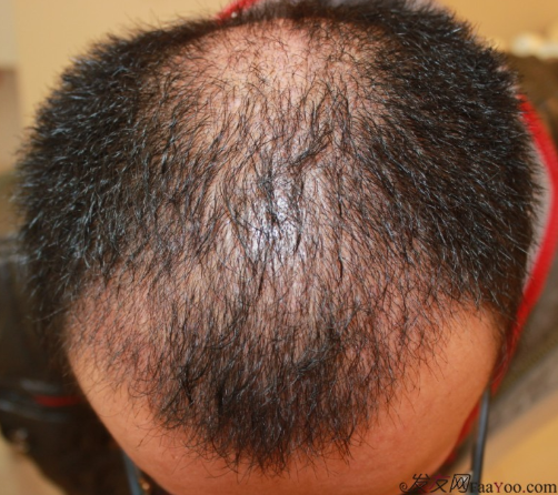 植發(fā)案例：感謝成都大麥微針植發(fā)王主任，咱是卷發(fā)咱怕誰