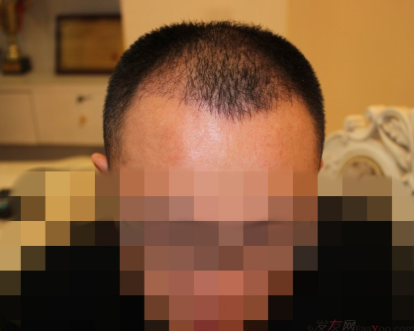 植發(fā)案例：感謝成都大麥微針植發(fā)王主任，咱是卷發(fā)咱怕誰