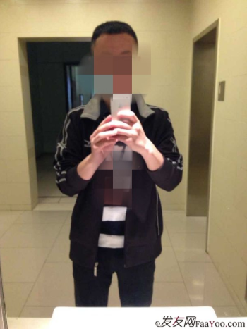 植發(fā)案例：感謝成都大麥微針植發(fā)王主任，咱是卷發(fā)咱怕誰